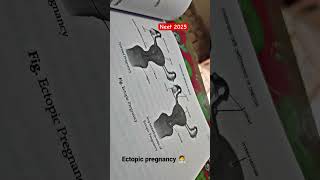 Ectopic pregnancy neet 2025 mbbs motivation viral video neet2025 neetstudytipsphysicswallah [upl. by Gader]