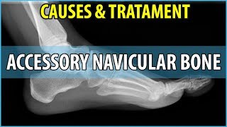 What is Accessory Navicular Bone Causes Symptoms and Treatments [upl. by Anaeli]