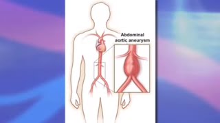 Risks and Benefits of Endovascular Abdominal Aortic Aneurysm Repair EVAR [upl. by Aisyat144]