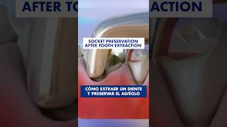 PRESERVACIÓN ALVEOLAR  Cómo evitar la reabsorción después de una EXTRACCIÓN DENTAL [upl. by Jr]