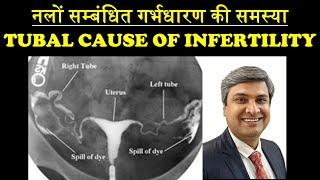 नलों सम्बंधित गर्भधारण की समस्या  TUBAL CAUSE OF INFERTILITY [upl. by Lhamaj]