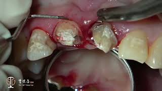 Restorative Crown Lengthening in Esthetic Zone amp Apicoectomy with Guided Tissue Regeneration II [upl. by Nrobyalc]