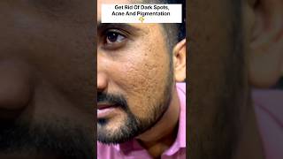 Get Rid Of Acne amp Dark SpotsAcne amp Pigmentation Removal PackGet Spotless Skin ytshortsviralAcne [upl. by Oirretna]