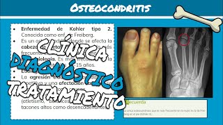 ⚕️🩺 Osteocondritis ENFERMEDAD DE KOHLER TIPO 1 Y TIPO 2 Síntomas Diagnóstico y Tratamiento [upl. by Dnomsaj109]