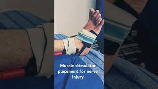 Muscle stimulator placement nerve injury physiotherapy viralvideo viralshorts pain motivation [upl. by Htenaj]