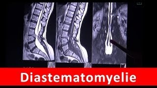 Diastematomyelie  Magnetresonanztomographie  by Radiologie TV [upl. by Ahsiekat]