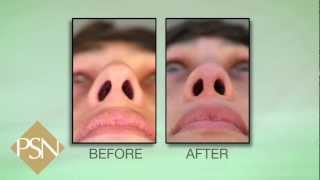 Rhinoplasty and Septoplasty [upl. by Hceicjow374]