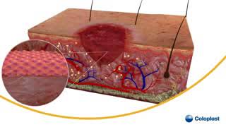 Stages of Wound Healing Process [upl. by Ramhaj]