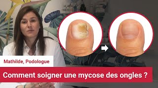 Soigner et reconnaitre la mycose des ongles des pieds  Conseil dune podologue [upl. by Adihsaar]