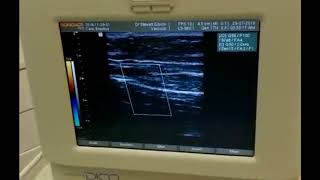 High flow in venous return Right saphenous [upl. by Goto513]