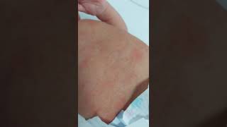 case 494 Erythema toxicum neonatorum [upl. by Warthman]