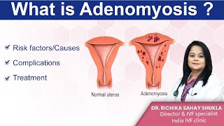 What is Adenomyosis Treatments Symptoms and Causes Dr Richika Sahay Shukla  India IVF Clinic [upl. by Okihsoy]