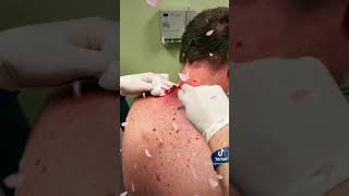 Las Vegas Dermatology Cyst Follow up video 🎥 with incision and drainage procedure 💉 🔪 [upl. by Ilarrold]