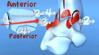 Lauge Hansen PER Pronation External Rotation Eversion Ankle Fracture [upl. by Ayaros]