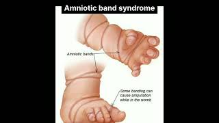 Amniotic Band syndromeDr Gohar Shahroz doctor short shortsfeed [upl. by Gnilhsa]