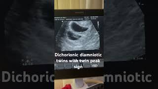 Dichorionic diamniotic twin pregnancylambda sign [upl. by Nelyaw]