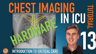 Chest Imaging in ICU  Part 2  Hardware [upl. by Eniluj]