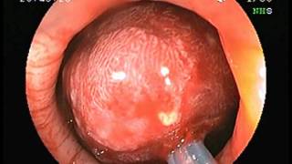 Polypectomy for large sigmoid colonic polyp [upl. by Free]