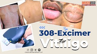 308Excimer For Vitiligo  Excimer Laser Treatment For Vitiligo by DrKailash  Clear Skin Kurnool [upl. by O'Kelly]