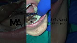 extraction of malposed lower second premolar using forceps [upl. by Menedez]