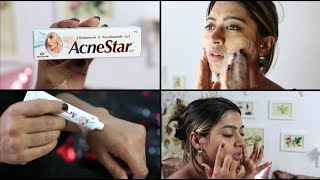 Acnestar Gel Review  HOW TO REALLY GET RID OF ACNE  SuperWowStyle Prachi [upl. by Airogerg573]