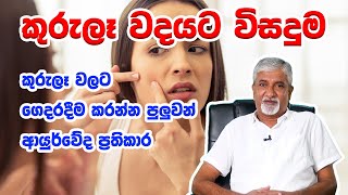 Pimples Clearing Easy Beauty Tips කුරුලෑ වදයට විසදුම  Ashoka Kumara Karunarathna [upl. by Einnoc]