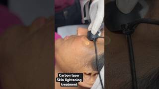 Carbon laser treatmentSkin lightening treatmentSkin smile clinic Bhopal ☎️9691918200 [upl. by Naujik]