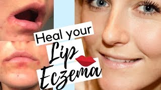 How To Heal Eczema On Lips  How To Treat Lip Eczema Naturally  Lip Eczema Treatment [upl. by Samau]