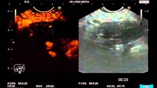 EUSGuided FineNeedle Aspiration for the Diagnosis amp Staging of Pancreatic Masses [upl. by Anawd186]