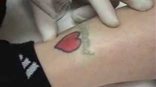 Laser Tattoo Removal Cherry Hill Laser amp Skin Care Center NJ [upl. by Danaher]