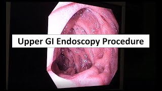 Upper GI Endoscopy Procedure in the ED [upl. by Nyleahcim]