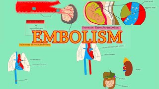 Pathology 18HDD 4  EMBOLISM  Pulmonary thromboembolism  Systemic thromboembolism AfSoomaali [upl. by Oriaj]