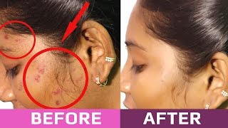 Tips to Remove Pimples Overnight  Beauty Tips in Tamil [upl. by Udela539]