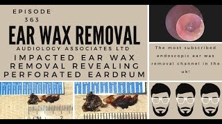 IMPACTED EAR WAX REMOVAL REVEALING PERFORATED EARDRUM EP363 [upl. by Ahseiat]