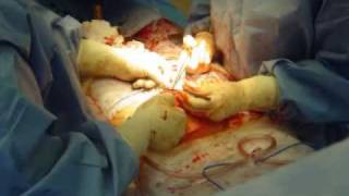 My Birth  Closing the Uterus  2007 Cesarean Delivery Surgery [upl. by Midas]