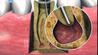 Nonsurgical management of periapical lesions [upl. by Veriee]