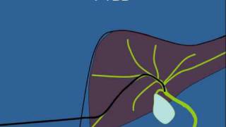 Biliary Stenting [upl. by Ardeid]