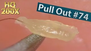 74 Pull Out Blackheads Close up 200X  Blackheads Removal [upl. by Siramad]