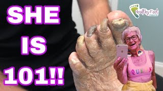 Shes 101 Years Old with Massive Thick Nails FUNGUS HUMONGOUS [upl. by Bascio]