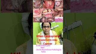 Is Leukoplakia transform to cancerWhen does leukoplakia turn into cancer White patch inside mouth [upl. by Osmond566]