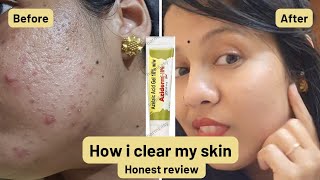 aziderm 10 reviewmy experience with azelaic acid gel in my acne journeybest cream for acne pimple [upl. by Ycak]