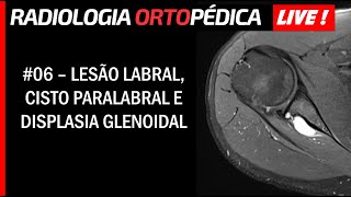 Live 06  Lesão Labral Posterior com Cisto Paralabral e Displasia da Glenóide [upl. by Dickson]