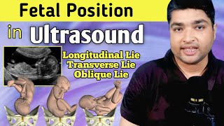 Fetal lie position and presentation in Ultrasound  Ultrasound kaise hota hai [upl. by Anastice]