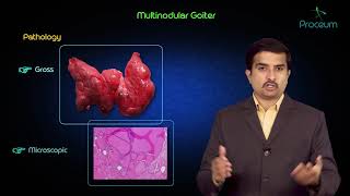 Multinodular goitre  Usmle step 1 pathology lecture and case presentation [upl. by Vershen]