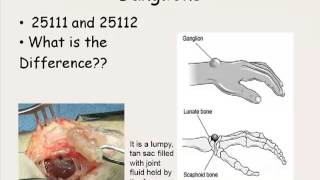 Hand Wrist Pain Hand Wrist and Finger Surgery Procedure [upl. by Sral]