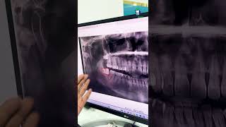 வலிக்காத ஞானப் பல்லையும் எடுத்து விடுங்கள்  Preventive Extraction of Wisdom Tooth  Denta Kings [upl. by Ettevroc]