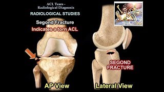 ACL Tears Radiological Evaluation  Everything You Need To Know  Dr Nabil Ebraheim [upl. by Annaitsirhc]