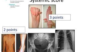 Marfan Syndrome  Diagnosis by Prof Julie De Backer [upl. by Nodmac119]