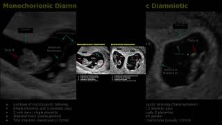 How is an 8 weeks dichorionic diamniotic twin pregnancy seen on ultrasound Possible lambda sign [upl. by Castillo]