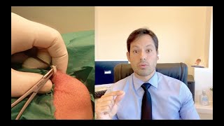 VASECTOMIA Explicando a cirurgia [upl. by Mckenzie]